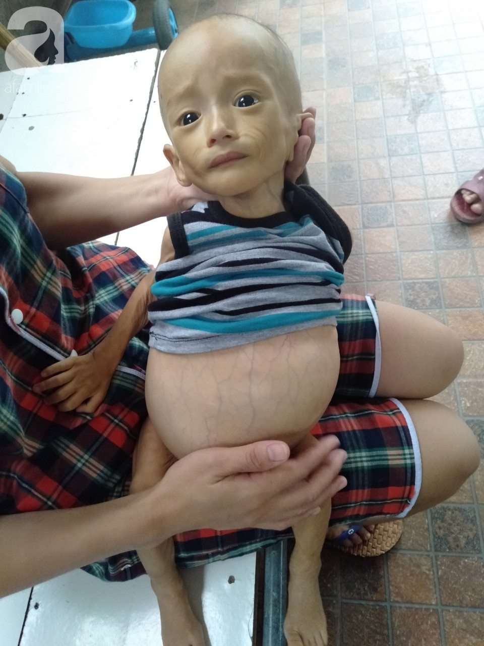 Sự sống mong manh của bé trai 1 tuổi, chỉ nặng 6kg, bụng phình to như cái trống mà mẹ nghèo không tiền chữa trị - Ảnh 10.