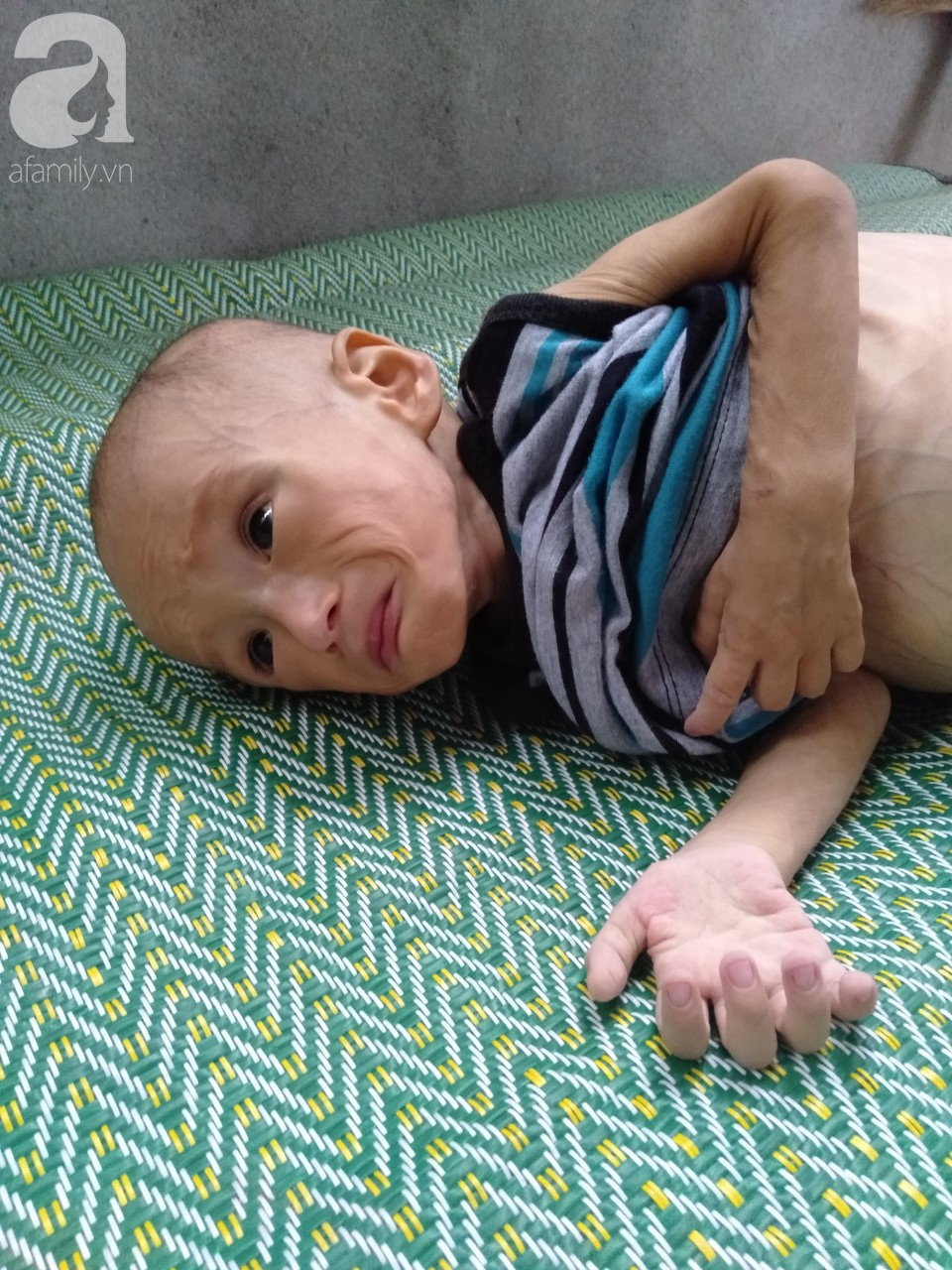 Sự sống mong manh của bé trai 1 tuổi, chỉ nặng 6kg, bụng phình to như cái trống mà mẹ nghèo không tiền chữa trị - Ảnh 4.