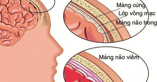 Từ vụ nữ sinh 18 tuổi tử vong do bị đau đầu, dấu hiệu cảnh báo căn bệnh nguy hiểm - Ảnh 2.