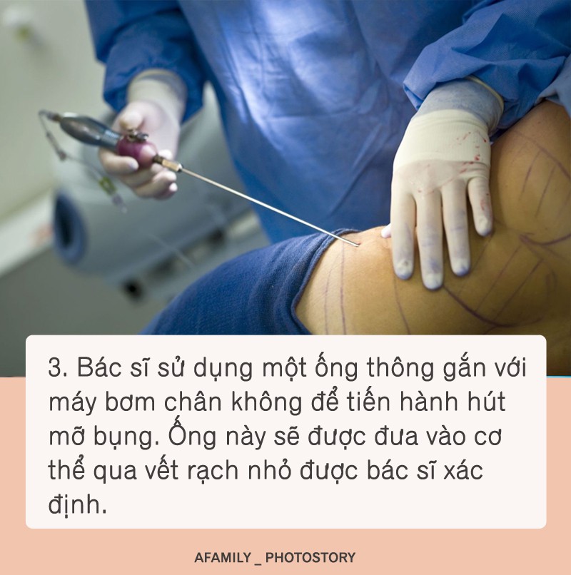 Hút mỡ bụng được chuyên gia thực hiện theo các bước như thế này, bước thứ 2 cực kì quan trọng - Ảnh 3.