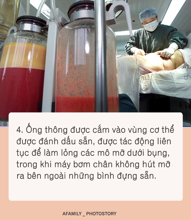 Hút mỡ bụng được chuyên gia thực hiện theo các bước như thế này, bước thứ 2 cực kì quan trọng - Ảnh 4.