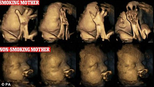 Những biến chứng kinh hoàng đối với thai nhi khi mẹ bầu hít phải khói thuốc lá - Ảnh 3.