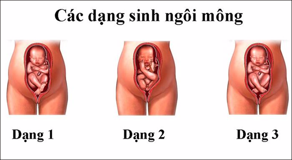 Sinh thường ngôi mông - Thách thức nguy hiểm cho cả mẹ bầu và bác sĩ sản khoa và đây là hình ảnh thực tế nhất - Ảnh 1.