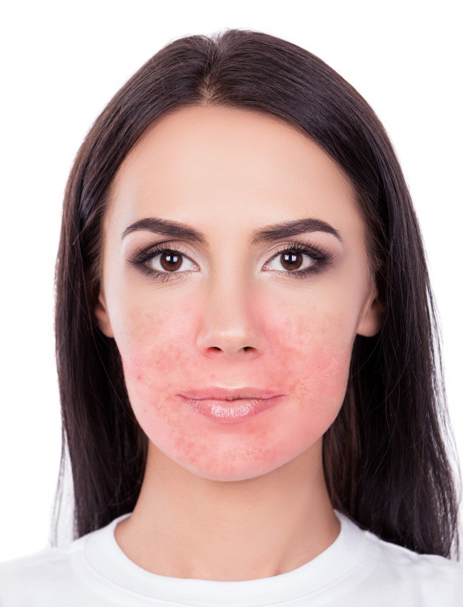 4 sản phẩm tự nhiên thường được khuyên để dưỡng da mặt nhưng thực ra lại gây hại không tưởng, chị em phải cẩn thận - Ảnh 4.