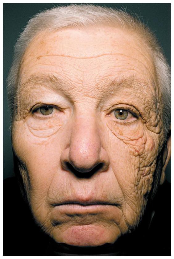 “Ham nhuộm da, không dùng kem chống nắng” – Người phụ nữ phải trải qua gần 90 lần phẫu thuật vì ung thư da - Ảnh 6.