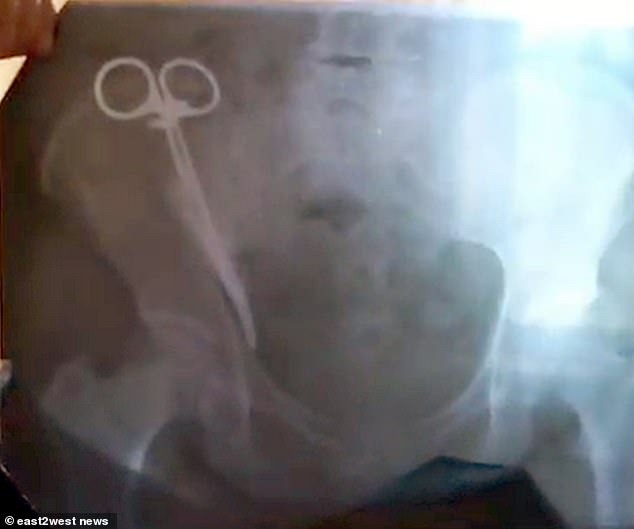Đau bụng nhưng tưởng bị bệnh gan trong 2 thập kỷ, người phụ nữ chụp X-quang mới sai phạm của bác sĩ khi sinh mổ 23 năm trước - Ảnh 3.