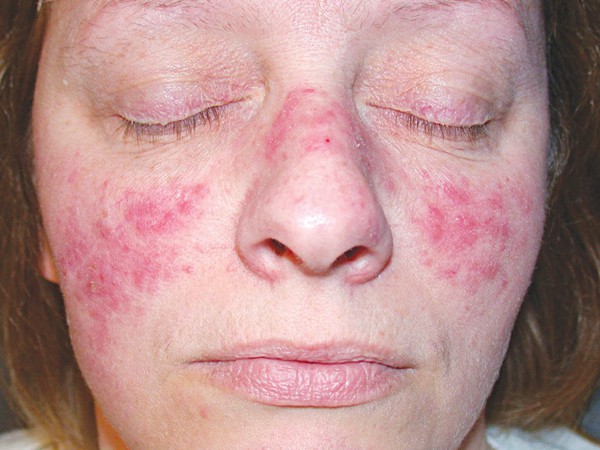 Mẹ bầu mắc lupus ban đỏ dễ gặp nguy cả mẹ lẫn con - Ảnh 1.