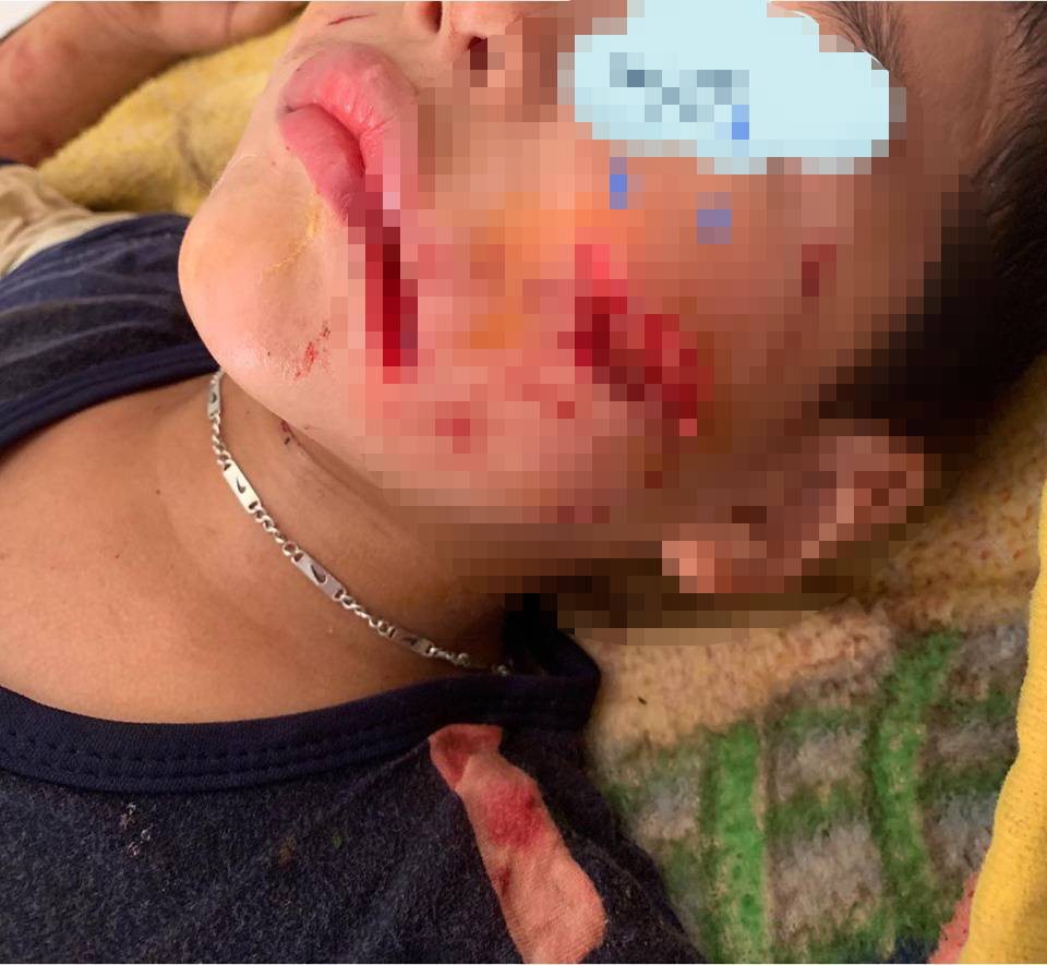 Sơn La: Kinh hoàng bé trai 6 tuổi bị chó nhà nuôi cắn nát mặt và đỉnh đầu - Ảnh 1.