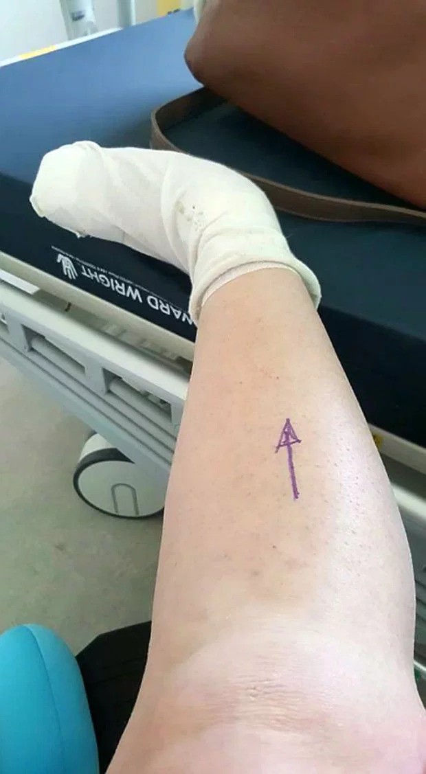 Bị lọ nước hoa rơi trúng chân, người phụ nữ chịu đựng nỗi đau suốt 2 năm trước khi buộc phải cắt bỏ một phần chân - Ảnh 3.