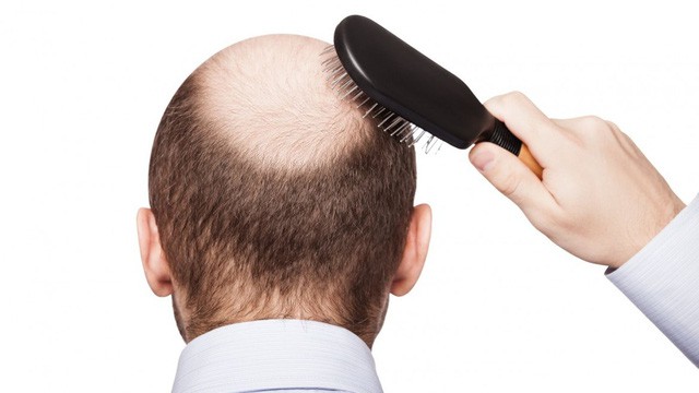 Tóc rụng nhiều, đây là cách đơn giản để tránh bị hói đầu cho cả nam và nữ - Ảnh 2.
