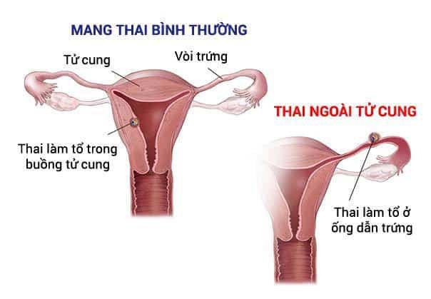 thai-ngoai-tu-cung-1