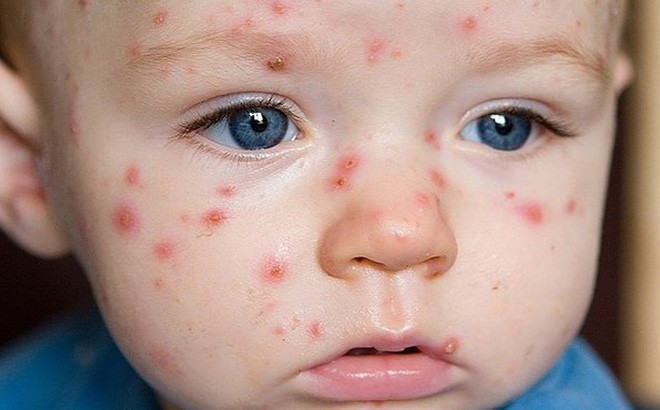 3 dấu hiệu phân biệt bệnh sởi và sốt phát ban để phòng tránh biến chứng nguy hiểm - Ảnh 1.