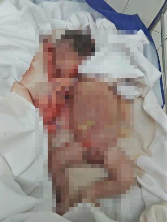 Vụ kéo đứt đầu trẻ sơ sinh ở Hà Tĩnh: Thai đã chết lưu 7 ngày