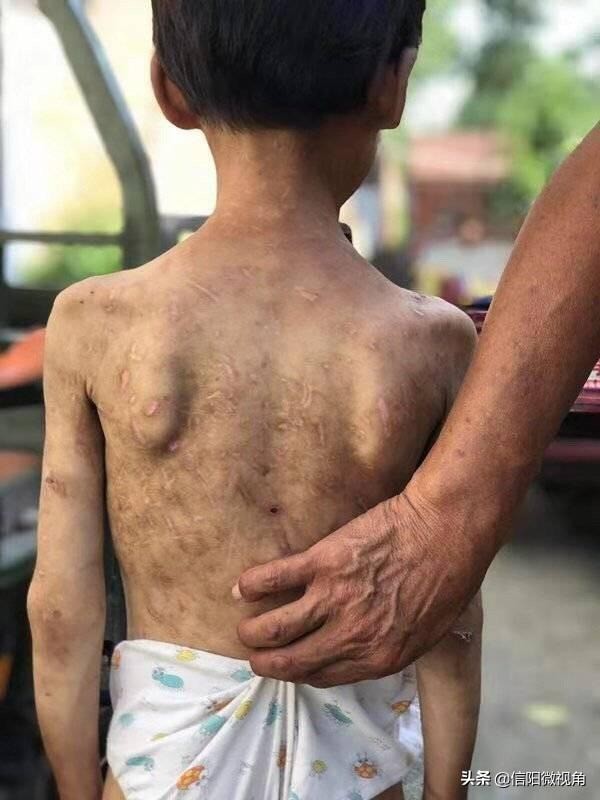 Cháu không nghe lời bị bà nội bạo hành, khi nhìn thấy vết thương trên người mọi người phẫn nộ đến mức muốn bỏ tù người bà ngay lập tức - Ảnh 1. Cháu không nghe lời bị bà nội bạo hành, khi nhìn thấy vết thương trên người mọi người phẫn nộ đến mức muốn bỏ tù người bà ngay lập tức - Ảnh 1.