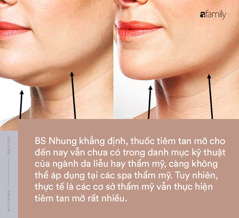 Tổng quan về tiêm tan mỡ nọng cằm