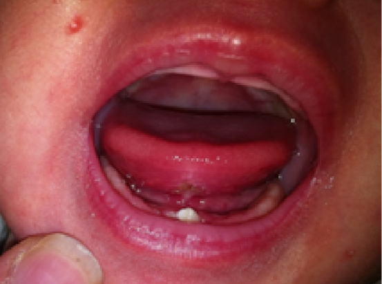 One-month-old-infant-showing-the-presence-of-two-natal-teeth-in-the-lower-arch-and