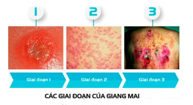 Tái mặt khi con mới 13 tuổi đã mắc lậu, giang mai - Ảnh 1. Tái mặt khi con mới 13 tuổi đã mắc lậu, giang mai - Ảnh 1.