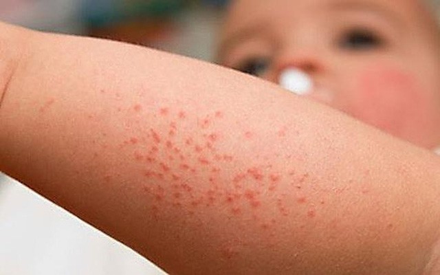 5 triệu chứng sốt xuất huyết ở trẻ em và cách phòng bệnh - Ảnh 1.