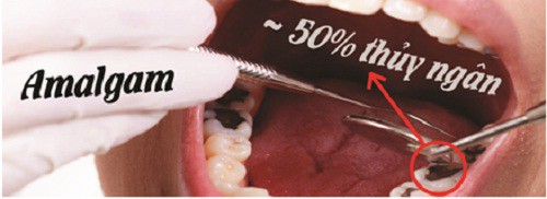 Amalgam – loại vật liệu hàn răng chứa Thủy ngân cần được loại bỏ - Ảnh 1.
