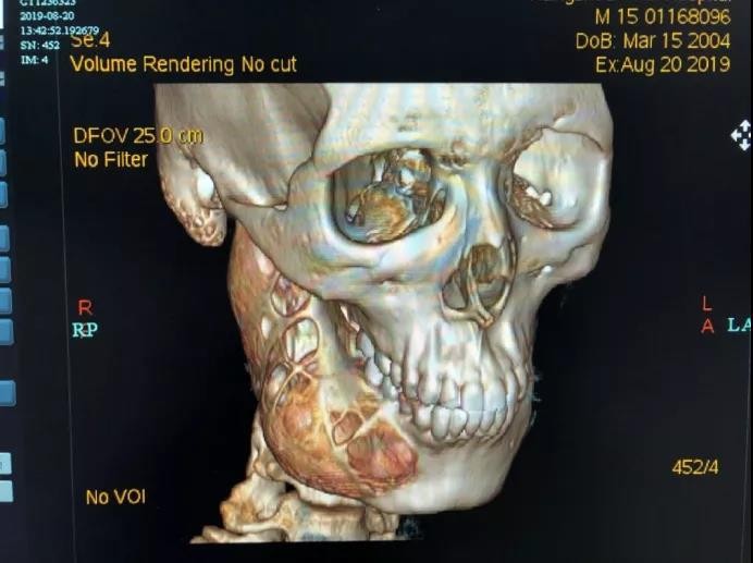 Đau răng 1 năm mới đi khám, cậu bé 15 tuổi khiến bác sĩ sốc khi thấy điều này trên phim X-quang - Ảnh 1.