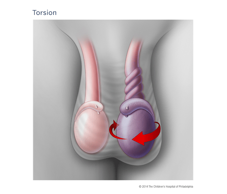 torsion-illustration