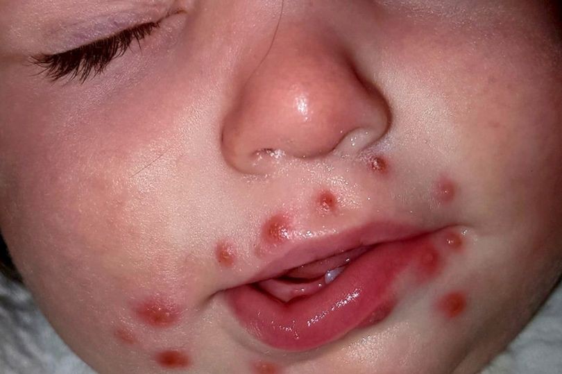 2_PAY-BABY-HERPES-FROM-A-KISS