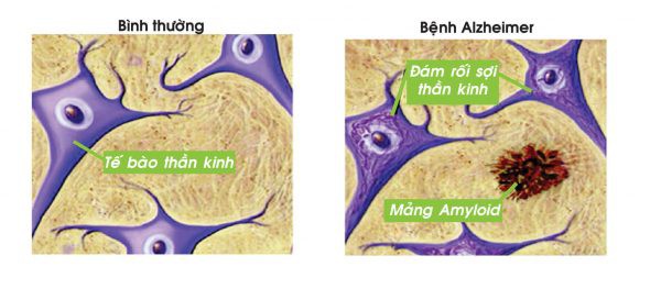 Công bố mới: Đã có vắc xin đặc trị chứng mất trí Alzheimer  - Ảnh 3.