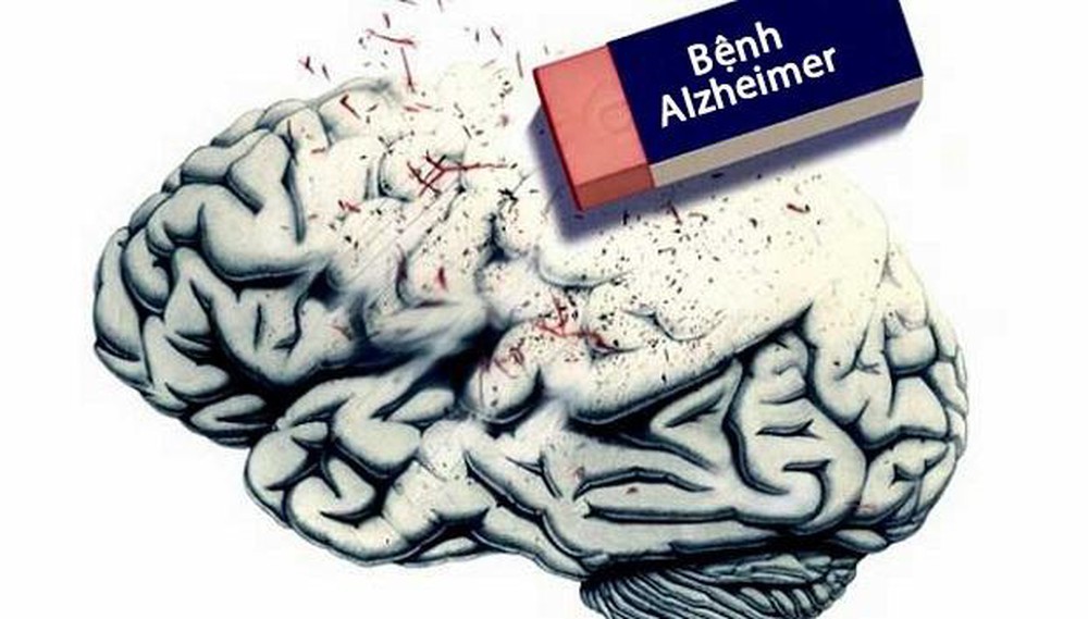 Công bố mới: Đã có vắc xin đặc trị chứng mất trí Alzheimer  - Ảnh 4.