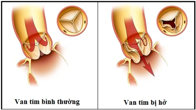 Bệnh tim khiến Tuấn Hưng đang phải nằm viện theo dõi nguy hiểm như thế nào? - Ảnh 3.