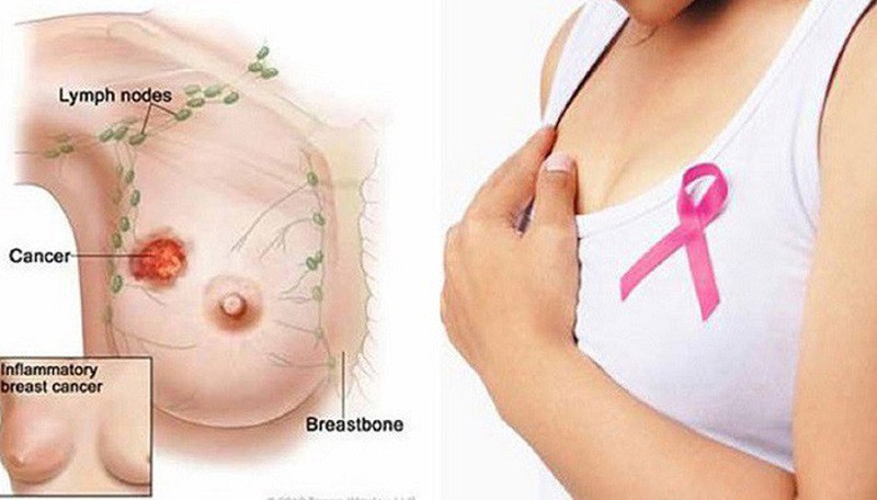 Hy hữu: 10 phụ nữ trong một gia đình cùng mắc bệnh ung thư vú - Ảnh 3. Hy hữu: 10 phụ nữ trong một gia đình cùng mắc bệnh ung thư vú - Ảnh 3.