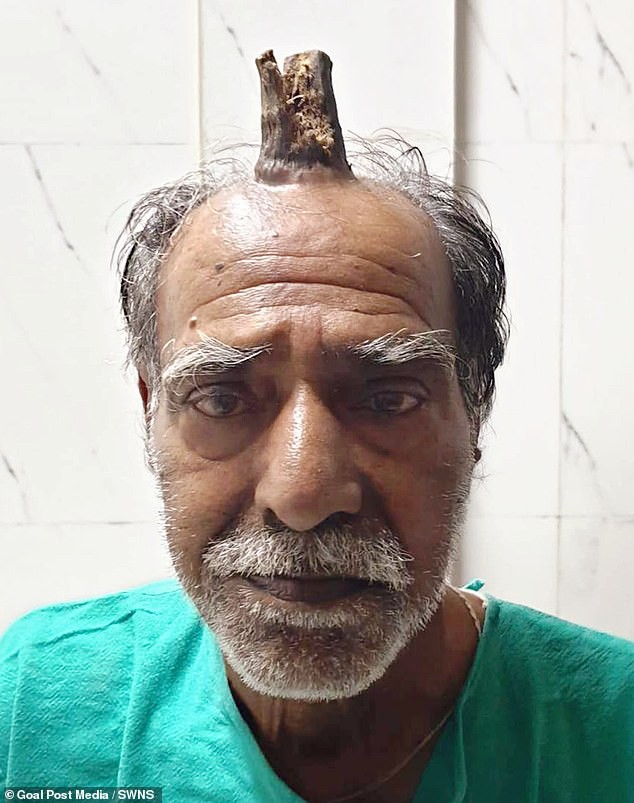 Căn bệnh lạ khiến cụ ông 74 tuổi bỗng dưng mọc thêm sừng trên đỉnh đầu - Ảnh 1.
