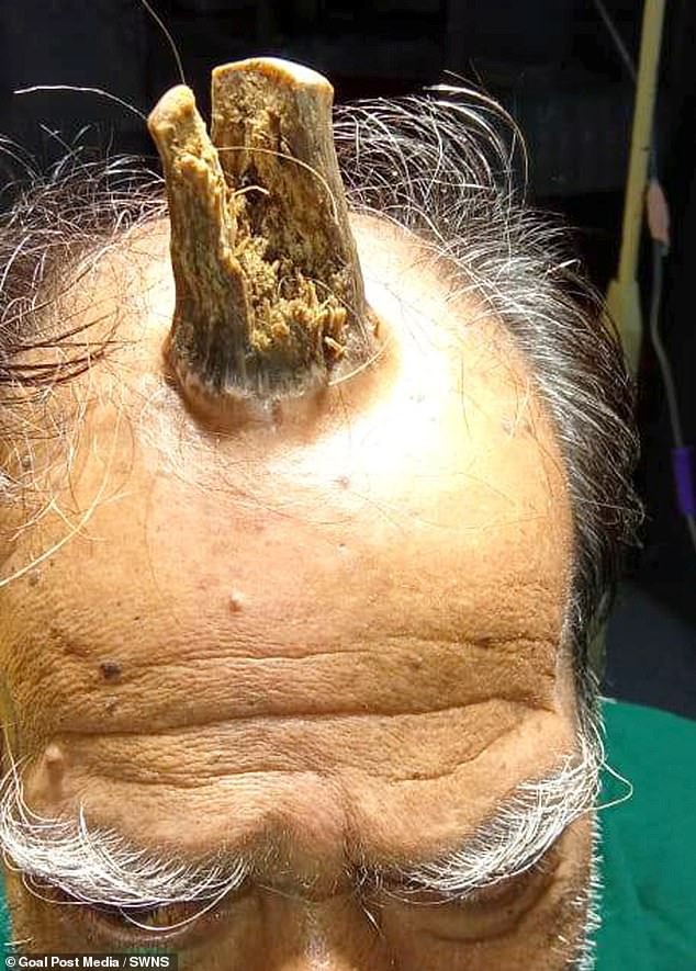 Căn bệnh lạ khiến cụ ông 74 tuổi bỗng dưng mọc thêm sừng trên đỉnh đầu - Ảnh 2.