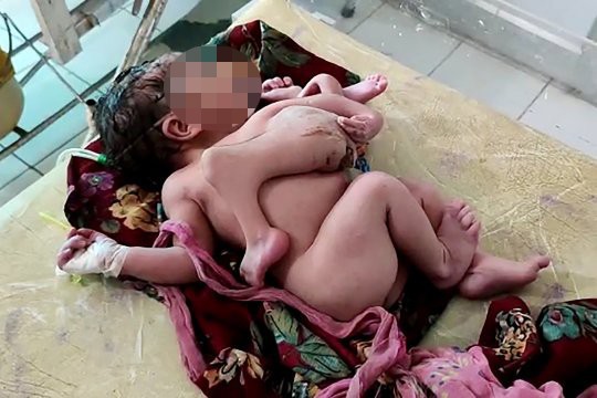 Mẹ bầu không siêu âm, sinh ra con có 3 tay 4 chân ở Ấn Độ - Ảnh 1.