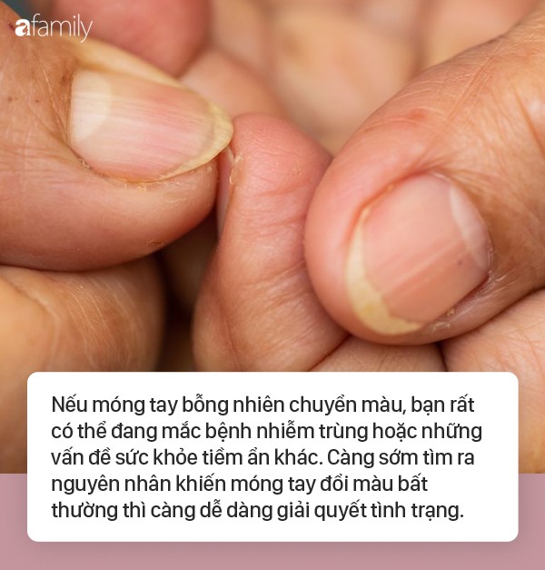 Móng tay vàng là dấu hiệu cảnh báo những vấn đề sức khỏe nghiêm: Để đảm bảo rằng bạn đang giữ gìn sức khỏe của mình, hãy tìm hiểu về tình trạng móng tay vàng. Điều này có thể là dấu hiệu của các vấn đề sức khỏe nghiêm trọng, hãy đến bác sĩ để được khám bệnh kịp thời.