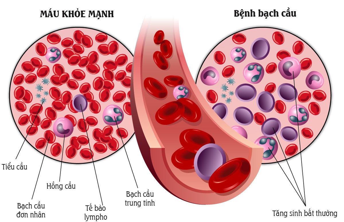 be-5-tuoi-bi-ung-thu