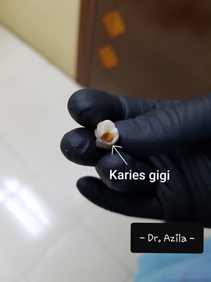msian-dentist-warns-parents-after-5yo-girl-almost-died-from-tooth-cavities-caused-by-overeating-sugary-food-world-of-buzz