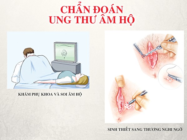 Tưởng chỉ là sợi lông mọc ngược vô hại ở vùng kín, ai ngờ lại là dấu hiệu của bệnh ung thư hiếm gặp - Ảnh 4.