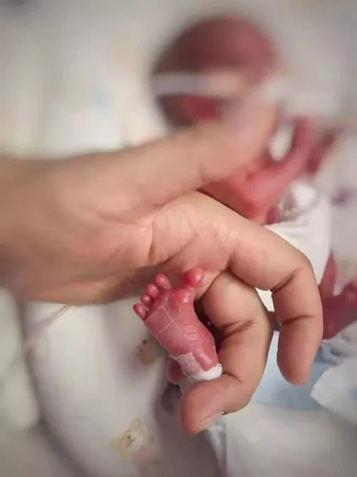 Em bé sinh non nặng 580g, chào đời trong tình trạng không có hô hấp, không mạch đập và may mắn sống sót - Ảnh 2.