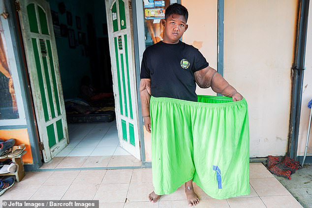 &quot;Cậu bé nặng nhất thế giới&quot; với gần 200kg sau 4 năm phẫu thuật thu nhỏ dạ dày giờ đã có được thân hình khác lạ hoàn toàn  - Ảnh 3.