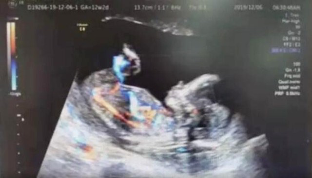 Mang thai ngoài tử cung 4 tháng, bác sĩ tìm mãi mới thấy vị trí ...