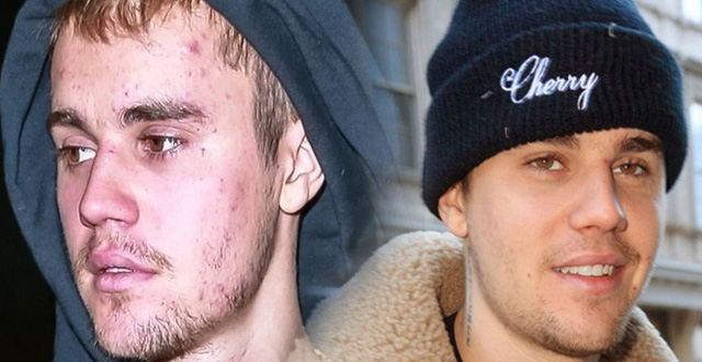 Không phải nghiện ma túy đá, Justin Bieber thực ra mắc phải cùng lúc 2 căn bệnh đáng sợ này - Ảnh 2.