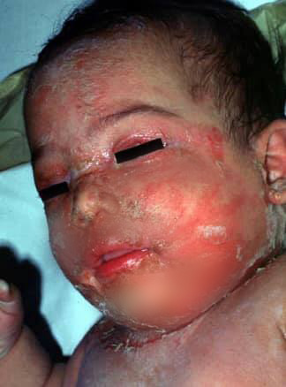 Mẹ anti vắc xin, bé 7 tháng tuổi bị lở loét đầy mủ, nguy kịch vì nhiễm trùng huyết - Ảnh 3.