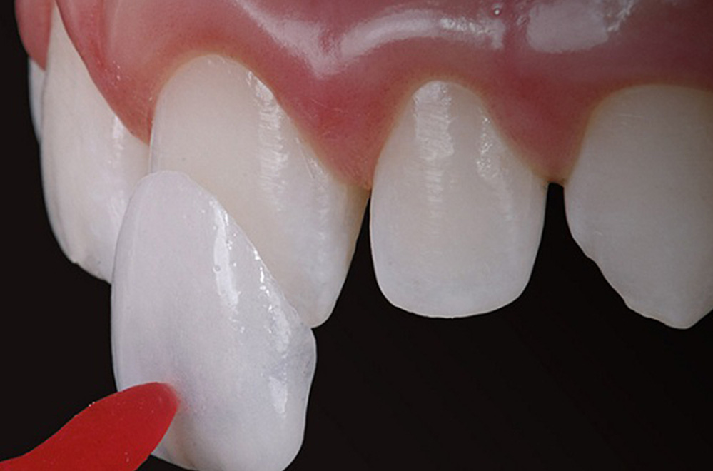 Các công nghệ làm răng sứ giúp hàm răng của bạn trắng sáng - Ảnh 4.