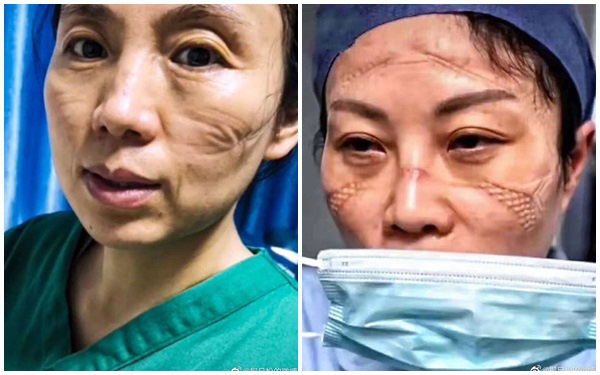 Gương mặt biến dạng in hằn khẩu trang của y, bác sĩ Vũ Hán và hé lộ chi tiết chuỗi ngày ám ảnh chiến đấu chống virus corona - Ảnh 3.