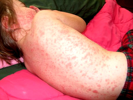 Phân biệt các bệnh có sốt và nổi ban