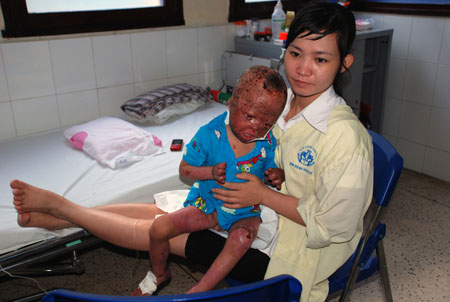 B&eacute; 3 tuổi bị bố đẻ tưới xăng đốt giờ ra sao? 2
