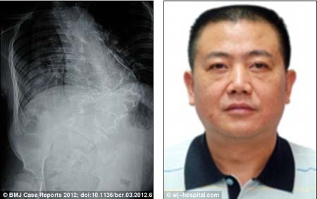 B&eacute; g&aacute;i c&oacute; tay... mọc tr&ecirc;n lưng 2