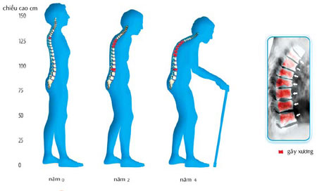 Những giải đáp về sức khỏe của bộ xương 1