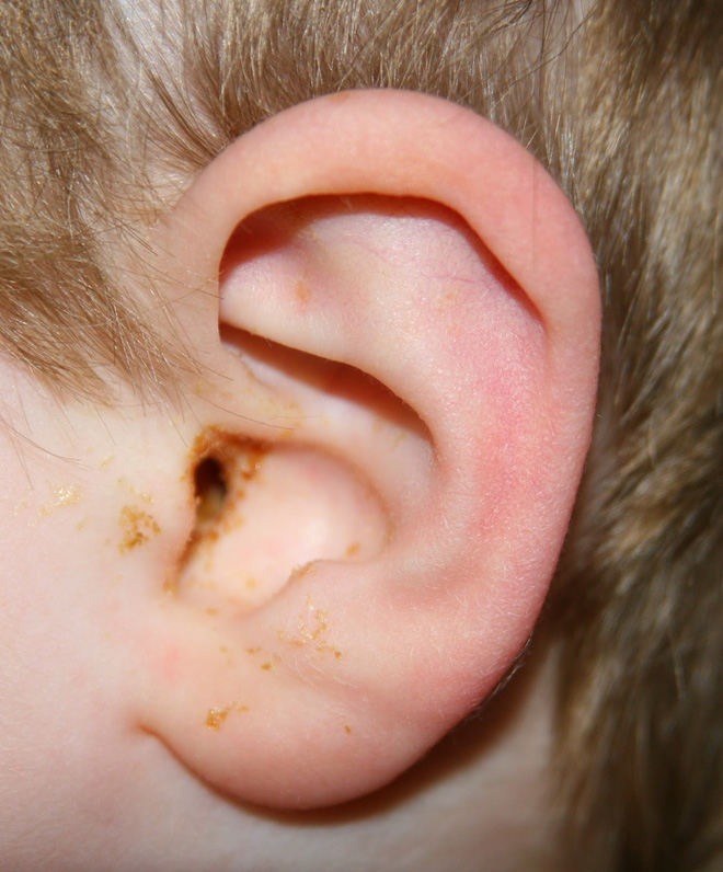 Muối + 1 chiếc tất: Trị hiệu quả viêm tai, nhiễm trùng tai cho trẻ - Ảnh 1.