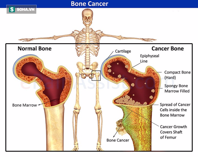 Những triệu chứng cảnh báo bệnh ung thư xương cần đi khám ngay - Ảnh 1.